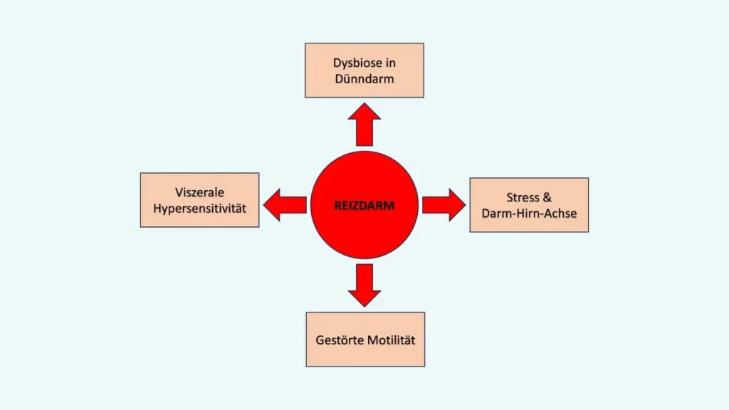 Infografik der vier Hauptmechanismen des Reizdarmsyndroms (RDS): Dysbiose, Motilität, Hypersensitivität und die Darm-Hirn-Achse.